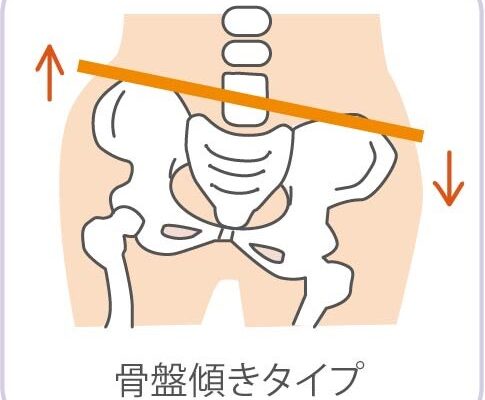 骨盤のゆがみケア②傾きタイプ